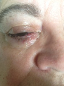 eye following surgery...