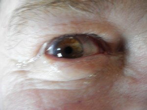 George's eye following cataract surgery...